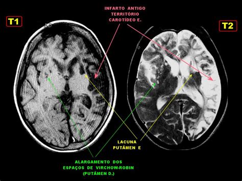 infarto cerebral subcortical